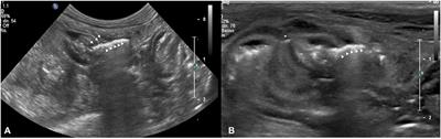 Ultrasonographic assessment of early leakage in intestinal sutures in dogs